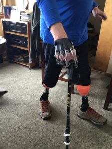 Prosthetic Legs and Fingers